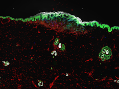 Spatial determinants of tumor cell dedifferentiation and plasticity in primary cutaneous melanoma
