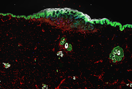Spatial determinants of tumor cell dedifferentiation and plasticity in primary cutaneous melanoma