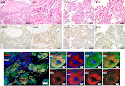 Clinical responses to trastuzumab deruxtecan in molecularly defined ependymoma.