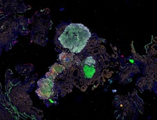 Multimodal spatial profiling reveals immune suppression and microenvironment remodeling in fallopian tube precursors to high-grade serous ovarian carcinoma