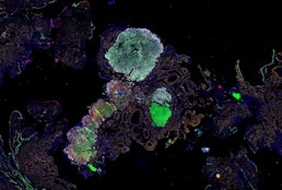 Multimodal spatial profiling reveals immune suppression and microenvironment remodeling in fallopian tube precursors to high-grade serous ovarian carcinoma