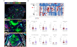 Multiomic analysis identifies suppressive myeloid cell populations in human TB granulomas.