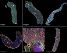 Multiple human transgenes prolong survival of triple-carbohydrate knockout porcine kidney xenografts in nonhuman primates.