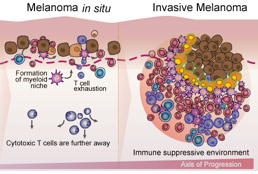 The spatial landscape of progression and immunoediting in primary melanoma at single cell resolution.