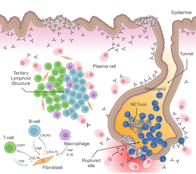Skin immune-mesenchymal interplay within tertiary lymphoid structures promotes autoimmune pathogenesis in hidradenitis suppurativa.